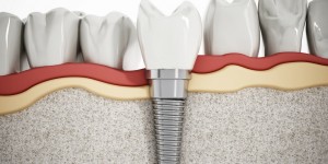 Illustration of teeth showing dental implant structure