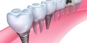 implant_img002