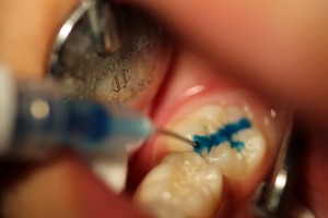 treatment_img004